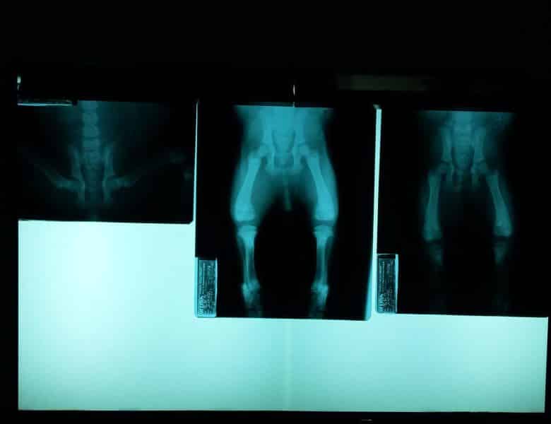 Tout savoir sur les varices pelviennes