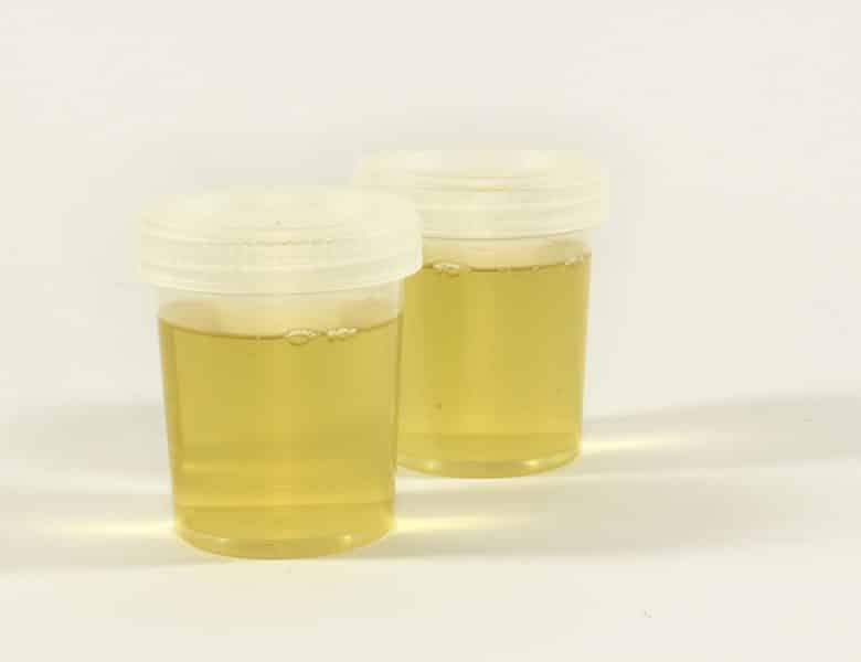 Faut-il s&rsquo;inquiéter d&rsquo;hématie dans les urines sans infection ?