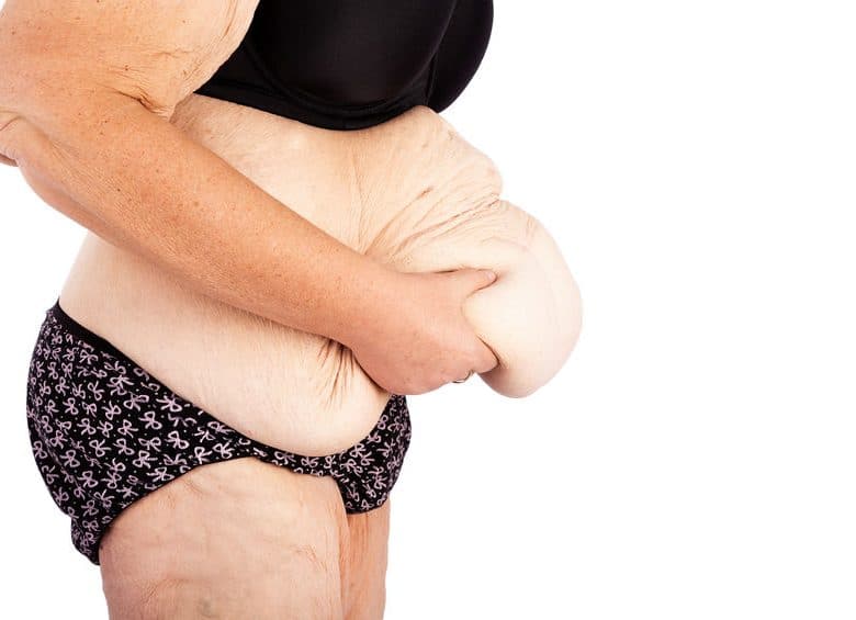 Tarif et déroulement d’une abdominoplastie