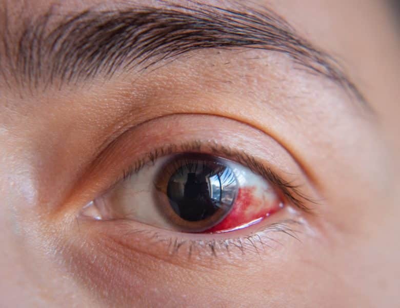 Présence de sang dans l&rsquo;œil, quand consulter ?