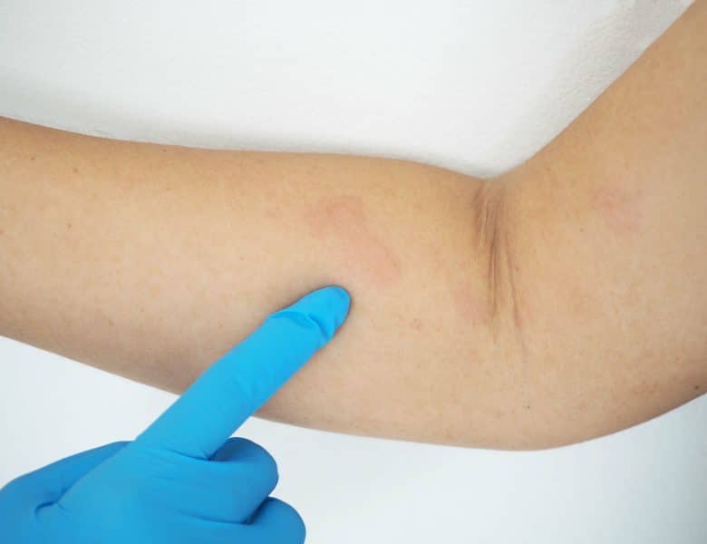 Pityriasis rosé de Gibert : tout ce que vous devez savoir sur cette affection cutanée