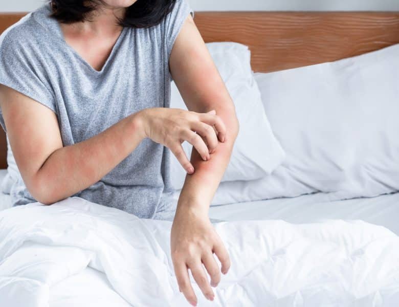 Piqûres de punaises de lit : Diagnostic, symptômes et solutions