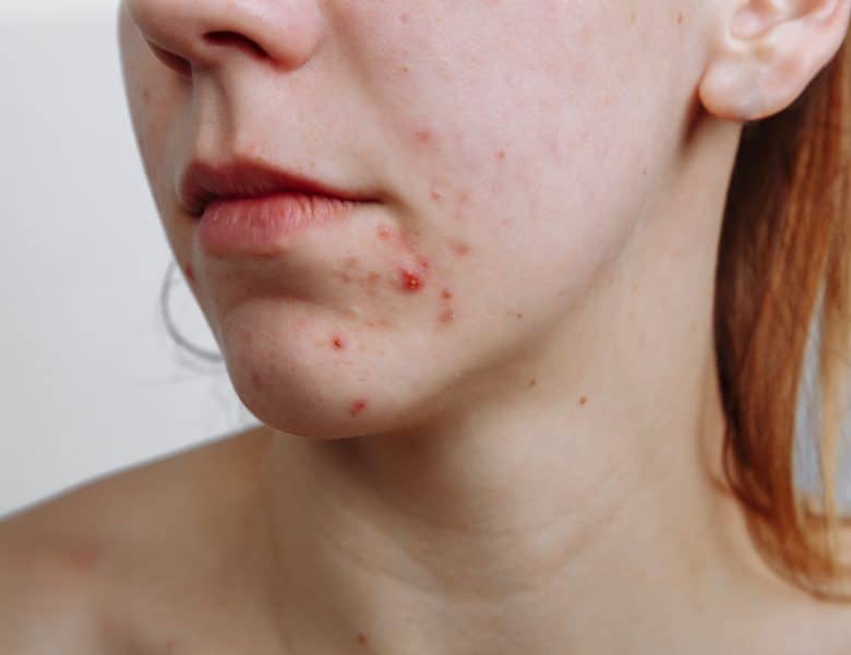 10 mythes sur les cicatrices post acné