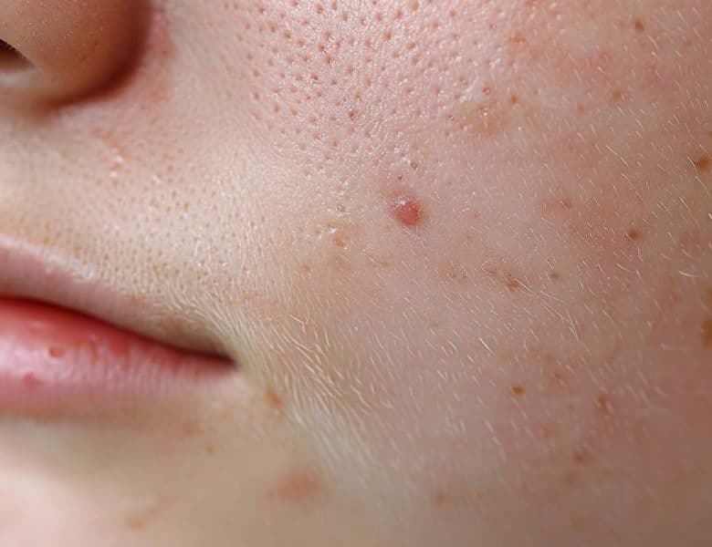 Ablation d&rsquo;un marisque : résultats avant et après l&rsquo;opération