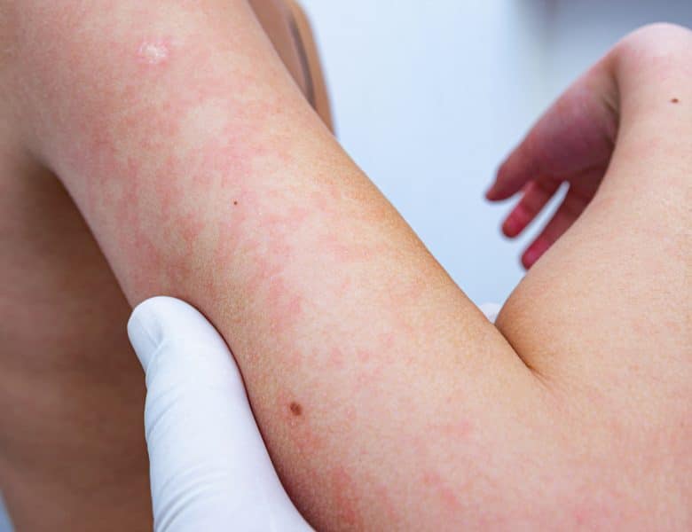 Comment apaiser les inflammations cutanées persistantes ?