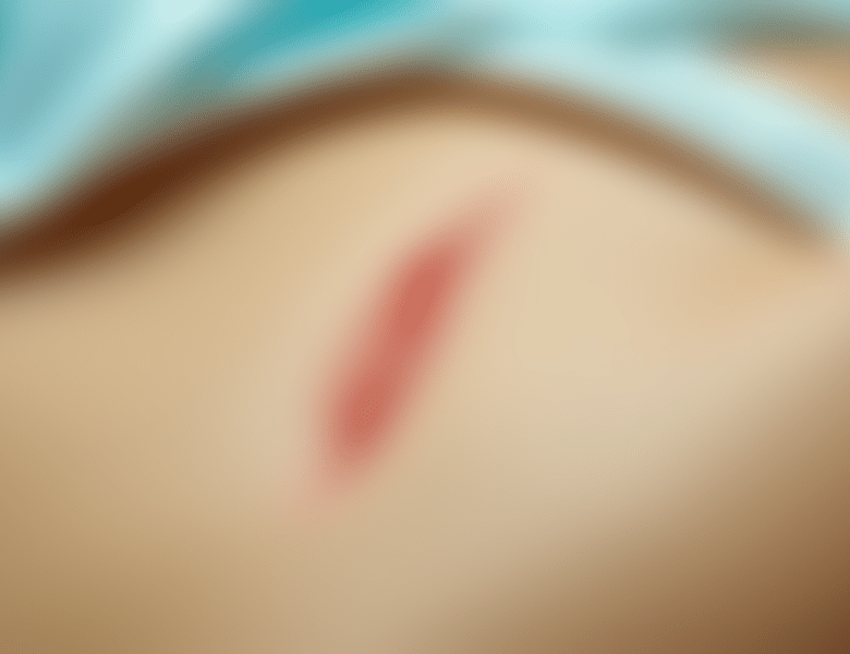 Quelles sont les conséquences d&rsquo;un kyste pilonidal après opération ?