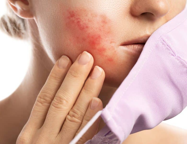 Érythrose : tout comprendre sur cette rougeur de la peau et ses soins