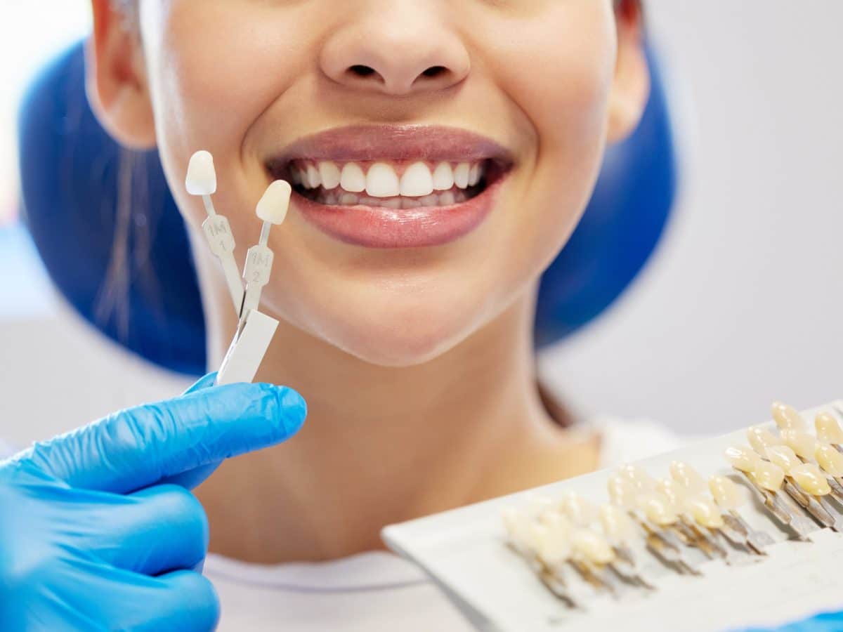 Facette dentaire : la solution esthétique pour corriger les imperfections des dents