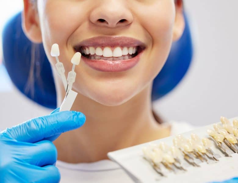 Facette dentaire : la solution esthétique pour corriger les imperfections des dents